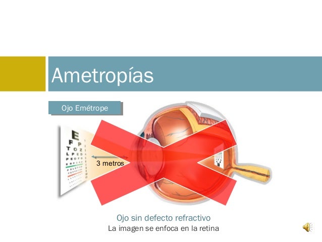 ametropias del ojo